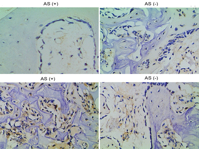  Differential protein levels of p53 and RUNX2 between AS+ and  AS− groups presented at the magnification of ×100