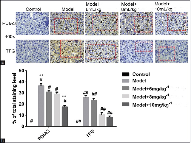 : (a) The immunohistochemical analysis of PDIA3 and TFG expression (light black stain) in liver tissues