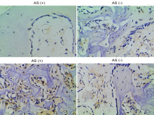  Differential protein levels of p53 and RUNX2 between AS+ and  AS− groups presented at the magnification of ×100