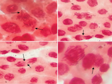  Photomicrograph of chromosomal abnormalities observed  after analysis of Allium cepa meristematic cells